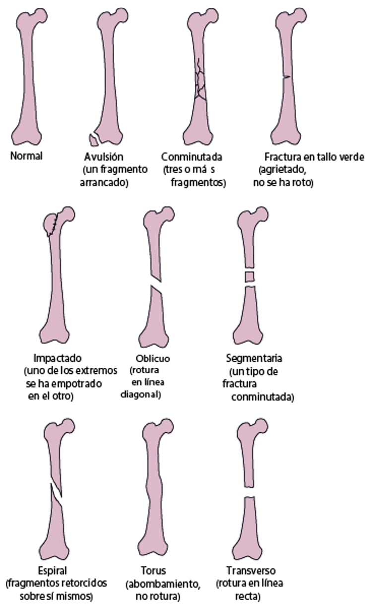 Algunos tipos de fracturas