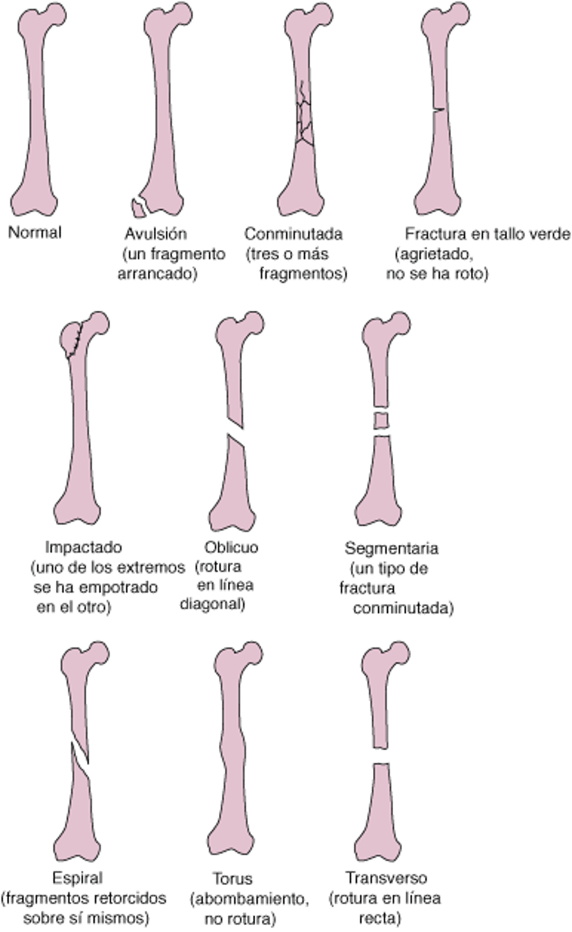 Algunos tipos de fracturas