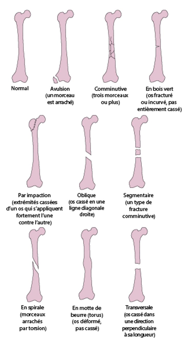 Certains types de fractures
