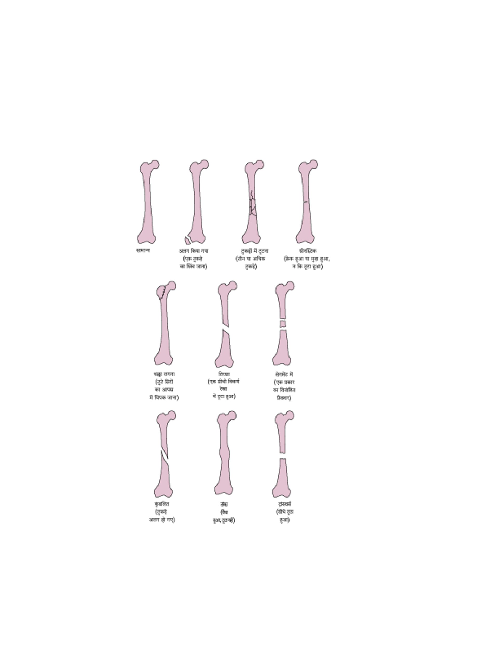 कुछ प्रकार के फ्रैक्चर