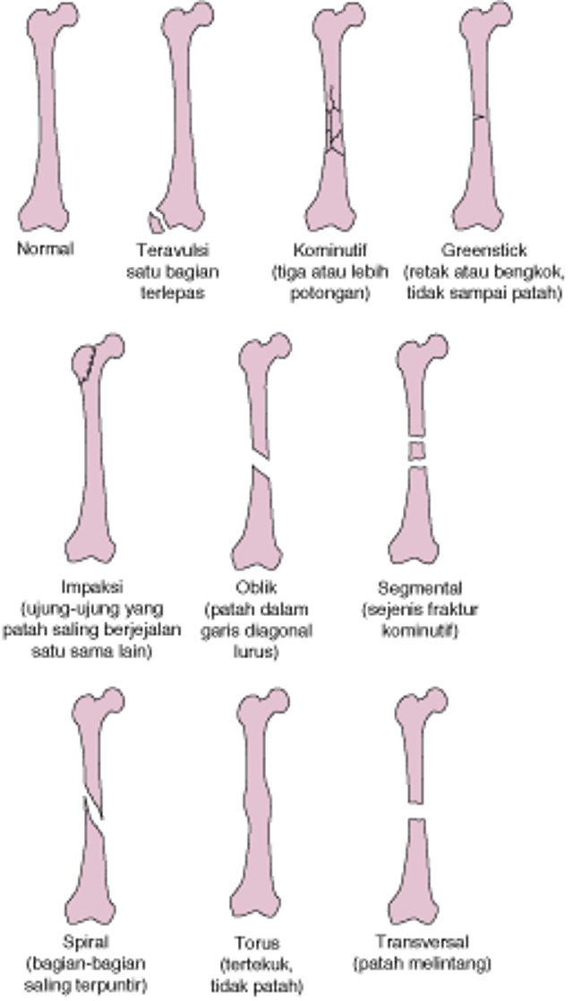 Beberapa Jenis Fraktur