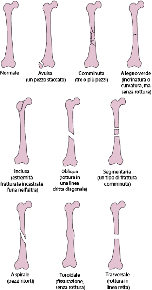 Alcuni tipi di fratture