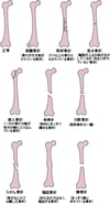 骨折こっせつのおもな種類しゅるい