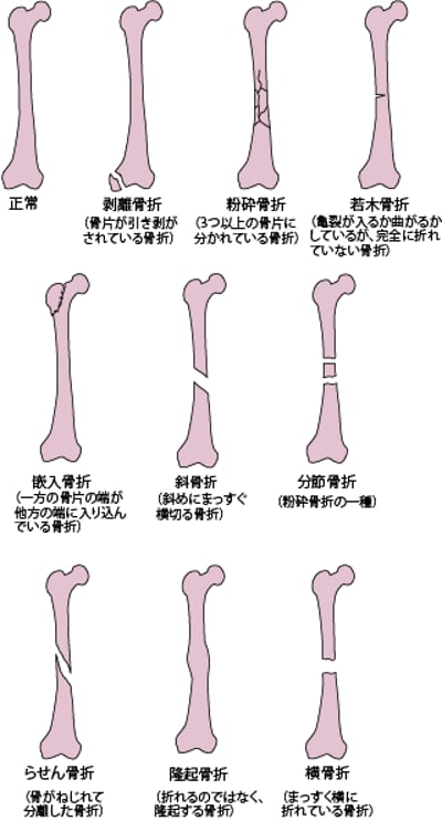 <ruby >骨折<rt >こっせつ</rt></ruby>のおもな<ruby >種類<rt >しゅるい</rt></ruby>