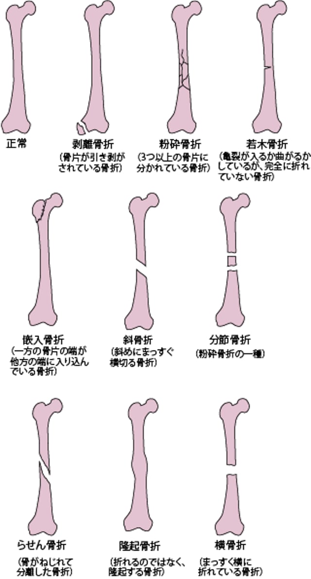 <ruby >骨折<rt >こっせつ</rt></ruby>のおもな<ruby >種類<rt >しゅるい</rt></ruby>