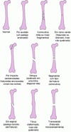 Alguns tipos de fraturas