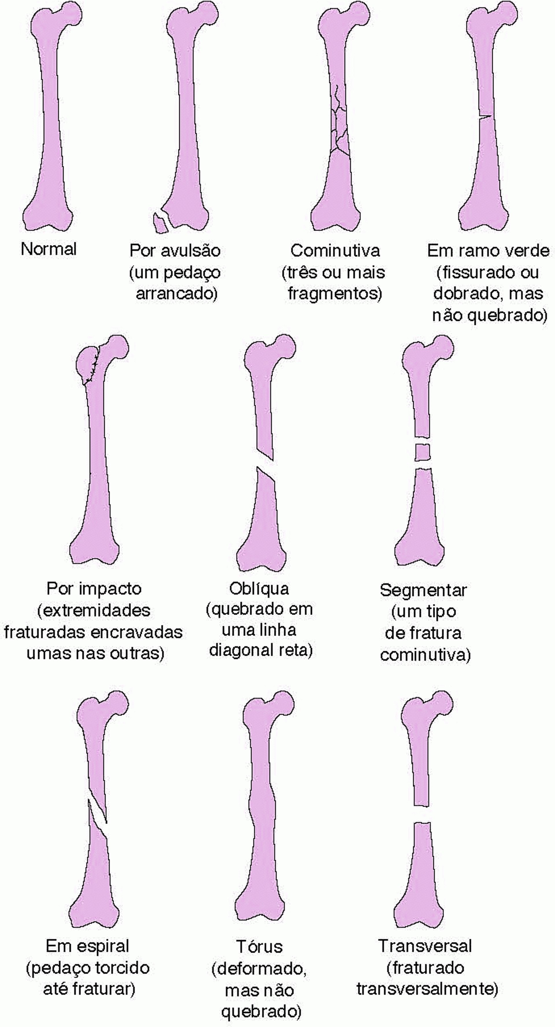 Alguns tipos de fraturas