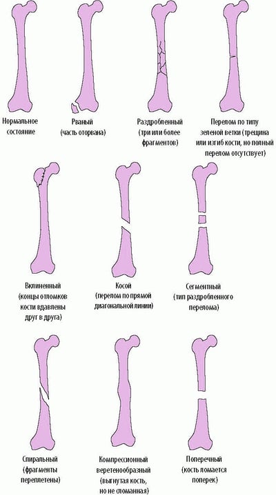 Некоторые типы переломов