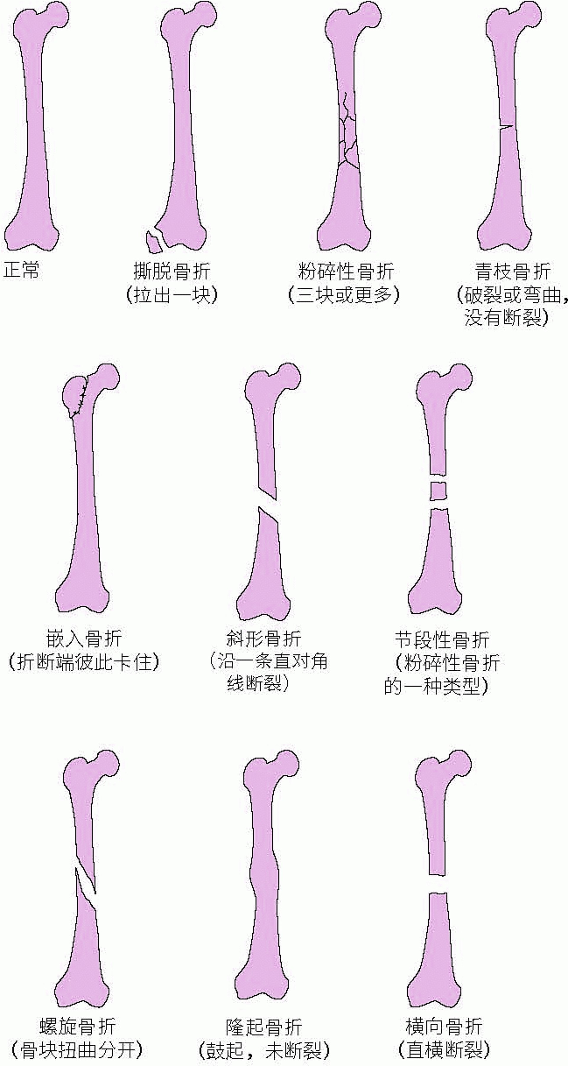 某些骨折类型