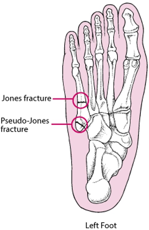 Image:Jones and Pseudo-Jones Fractures-MSD Manual Consumer Version