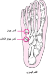 كُسُورُ جونز وكُسور جونز الكاذِبة Jones and Pseudo-Jones Fractures