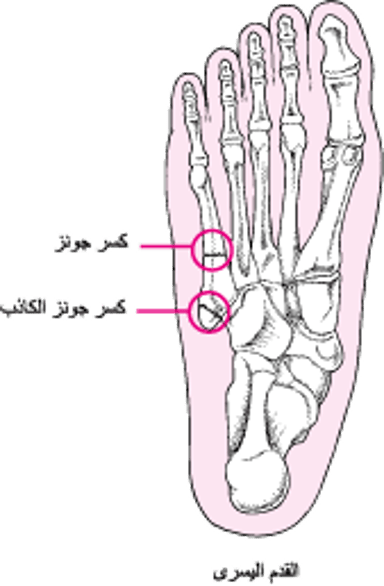 كُسُورُ جونز وكُسور جونز الكاذِبة Jones and Pseudo-Jones Fractures