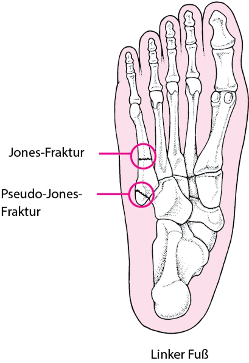 Jones- und Pseudo-Jones-Frakturen