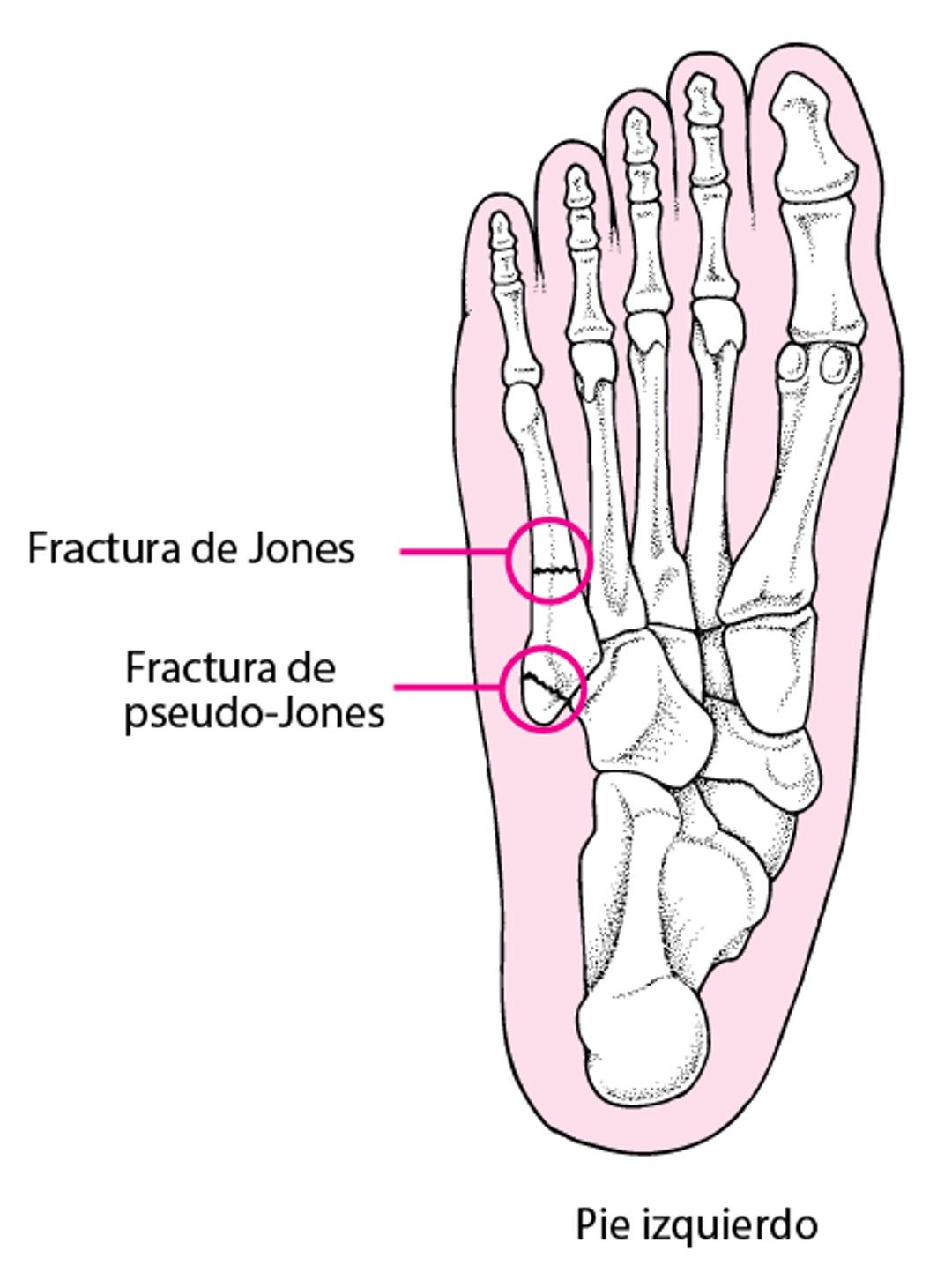 Fractura de Jones y fractura por avulsión (pseudo-Jones)