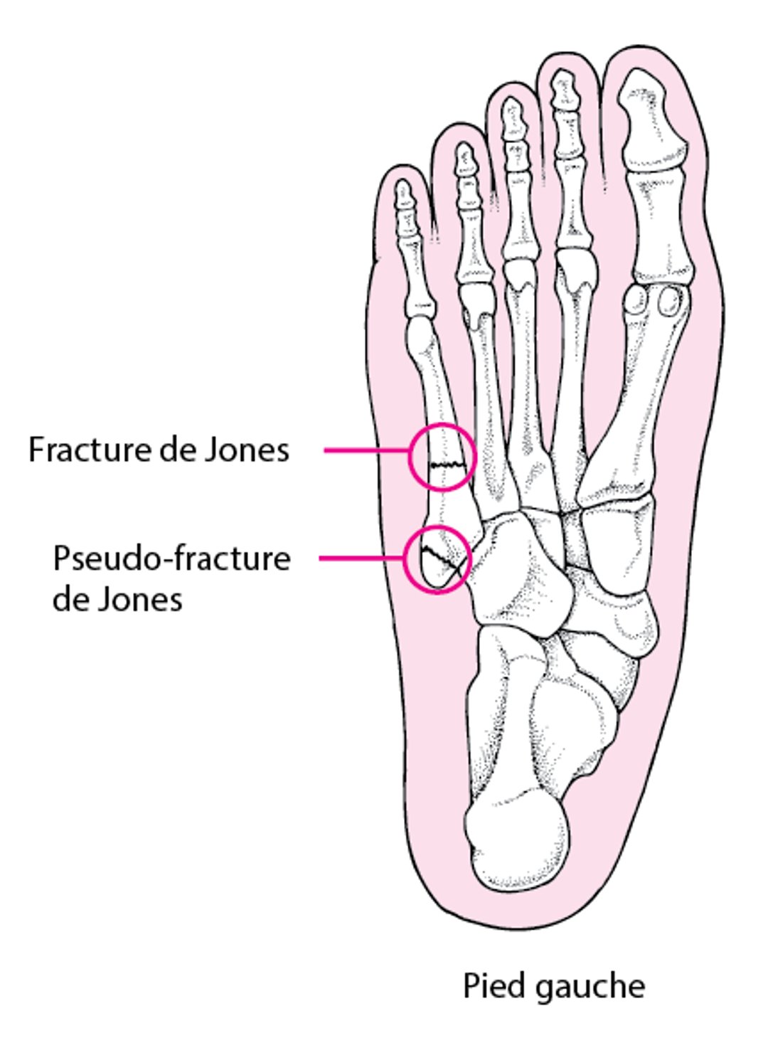 Fractures de Jones et pseudo-fractures de Jones