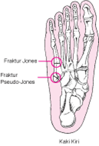 Fraktur Jones dan Pseudo-Jones