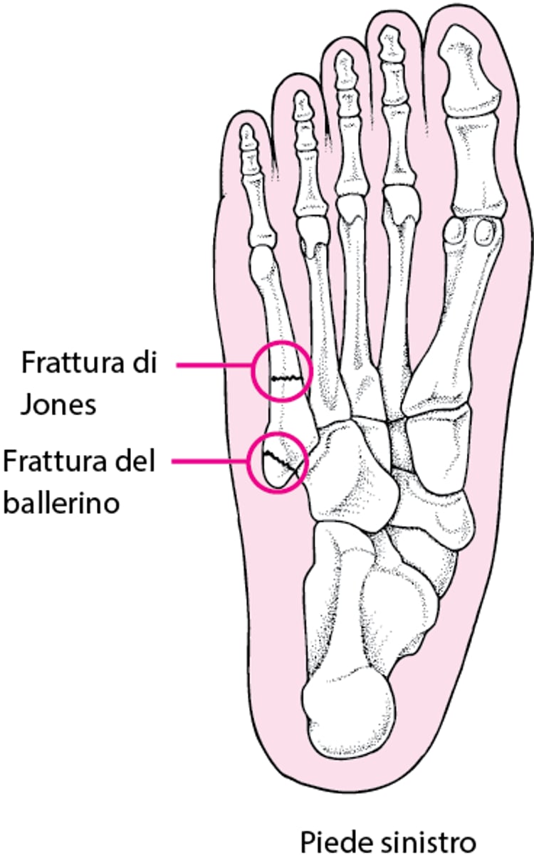 Frattura di Jones e frattura del ballerino