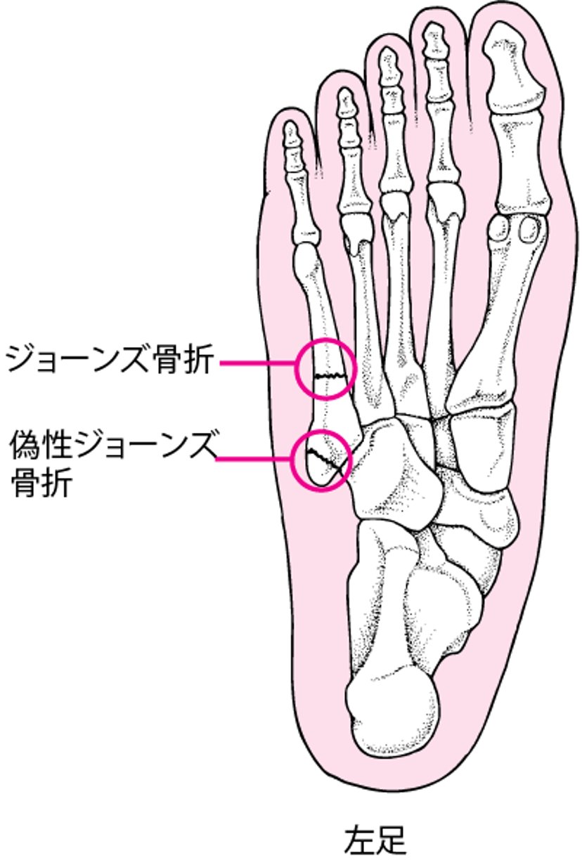 ジョーンズ骨折と偽性ジョーンズ骨折