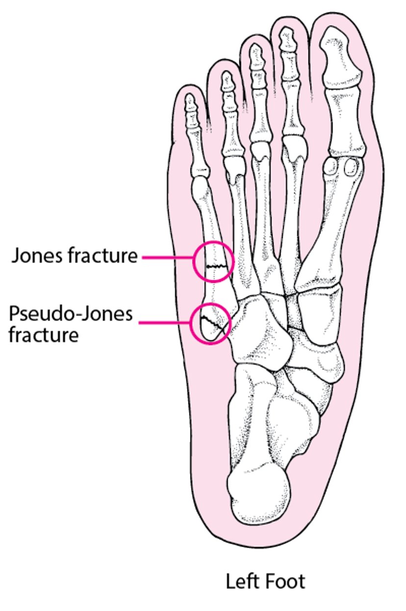 존스 및 가성 존스 골절