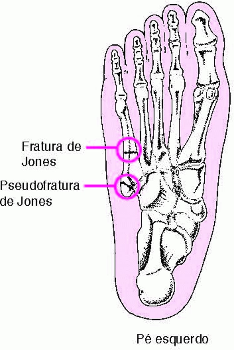 Fraturas de Jones e pseudofraturas de Jones