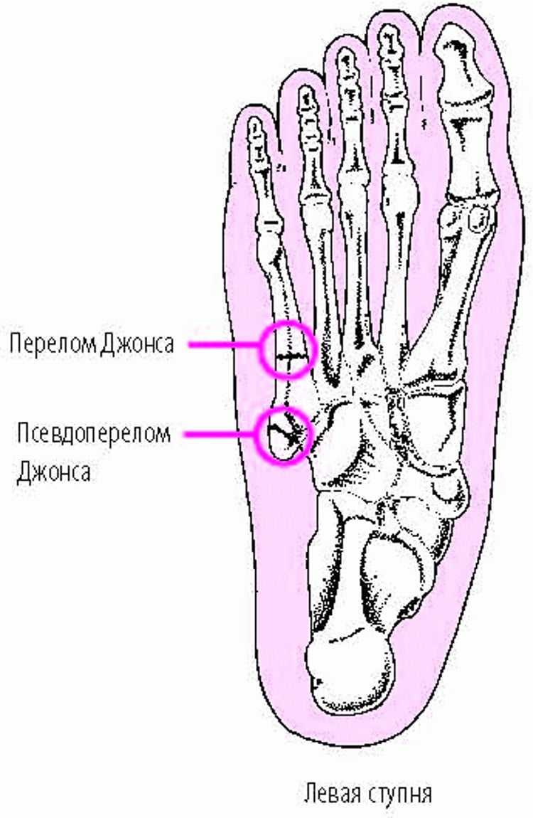 Переломы Джонса и псевдопереломы Джонса