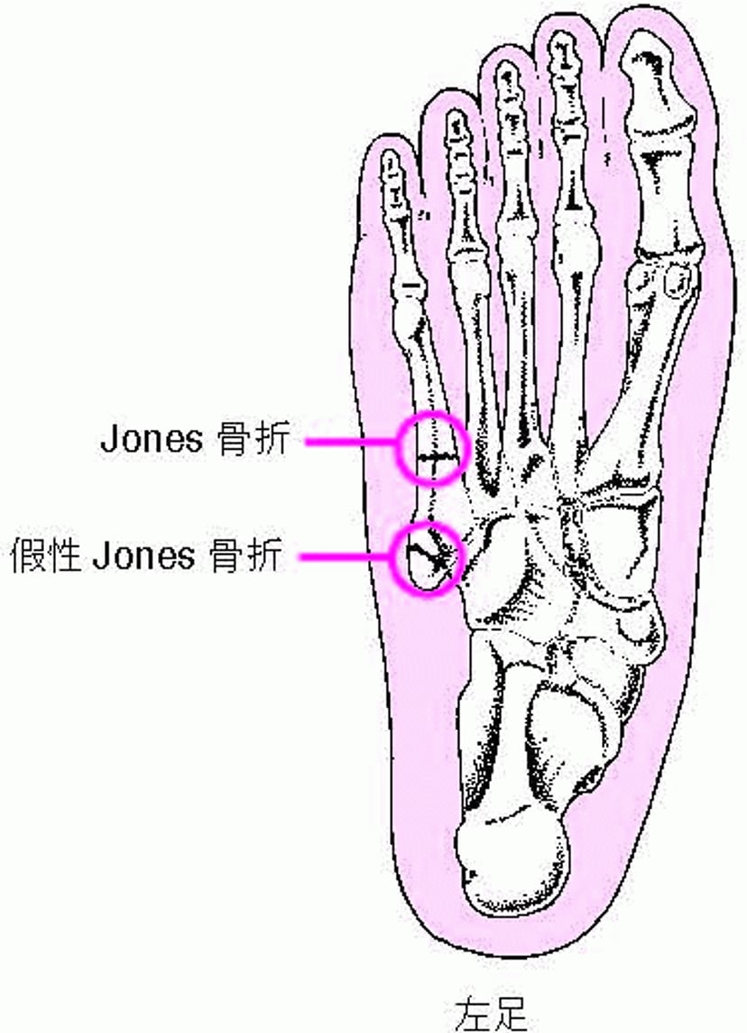 Jones骨折和Pseudo-Jones骨折