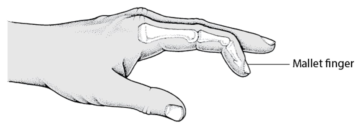 Mallet Finger