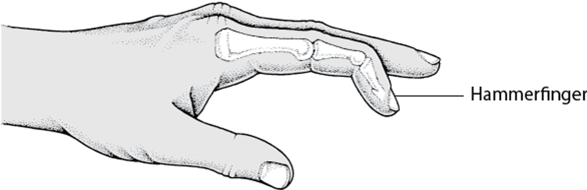 Hammerfinger