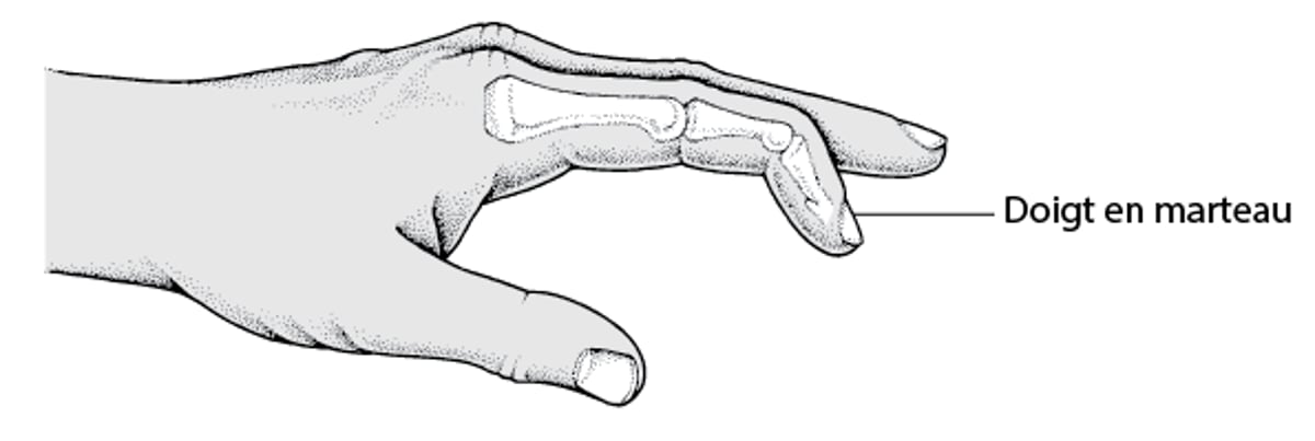 Doigt en maillet