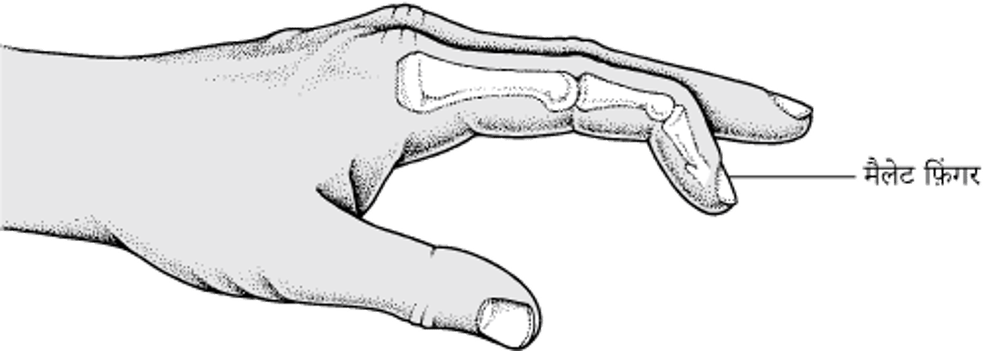 मैलेट फ़िंगर