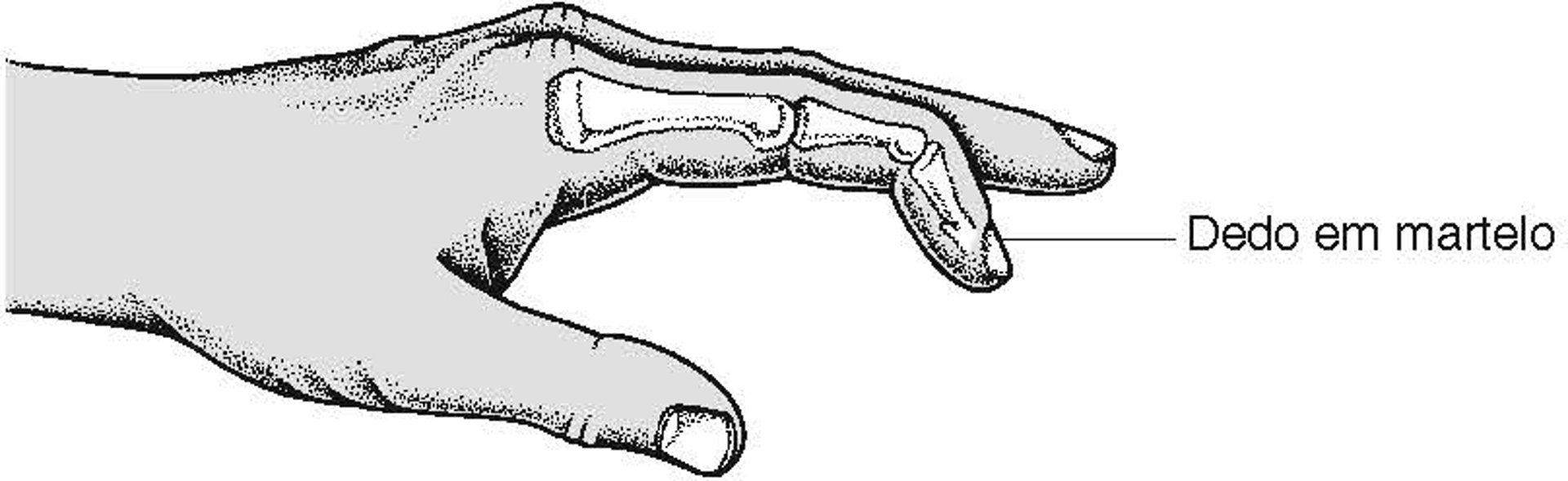 Dedo em martelo