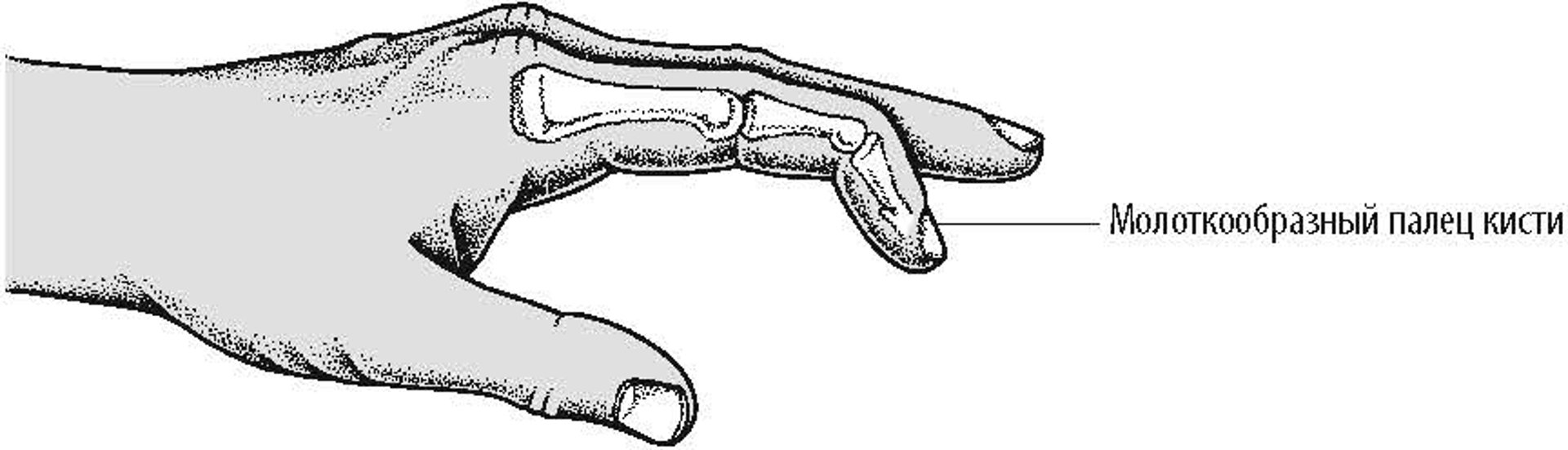 Молоткообразная деформация пальцев