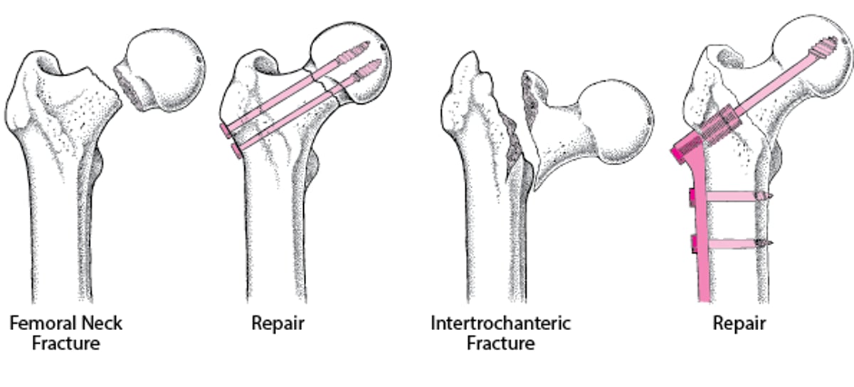 Repairing a Fractured Hip