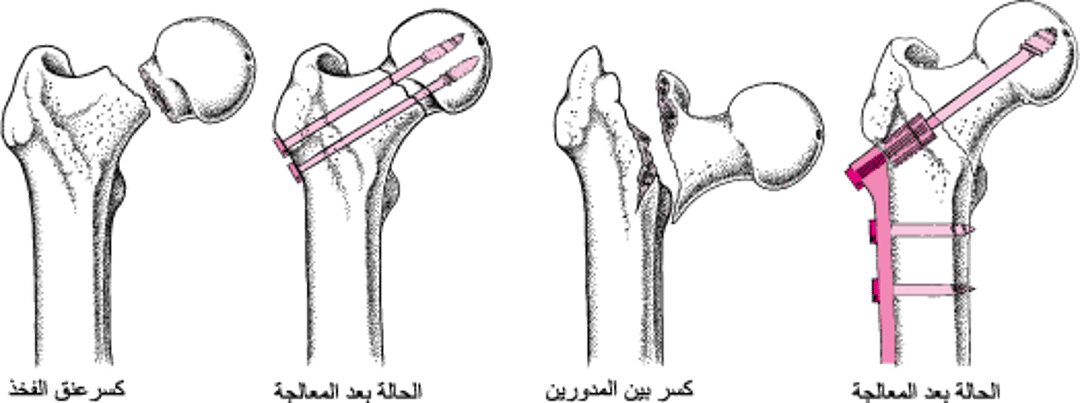 إصلاحُ الورك المكسُور