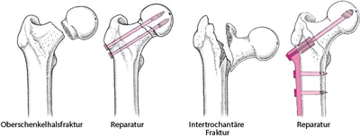 Wiederherstellung einer gebrochenen Hüfte