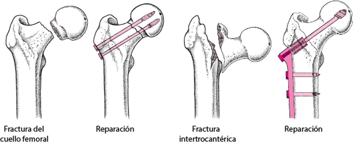 Reparación de una cadera fracturada
