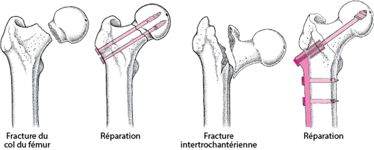 Réparation d’une fracture de la hanche