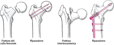 Riparazione di una frattura dell’anca