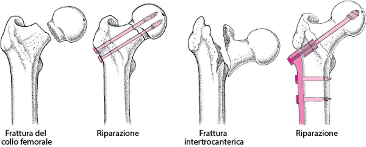 Riparazione di una frattura dell’anca