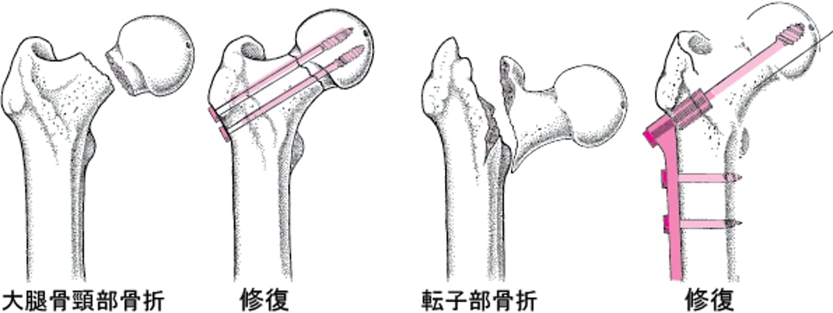 骨折した股関節の修復