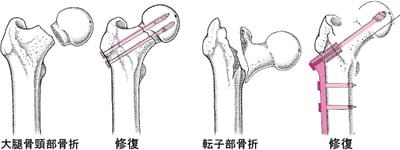 骨折した股関節の修復