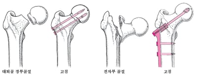 골절된 고관절 치환