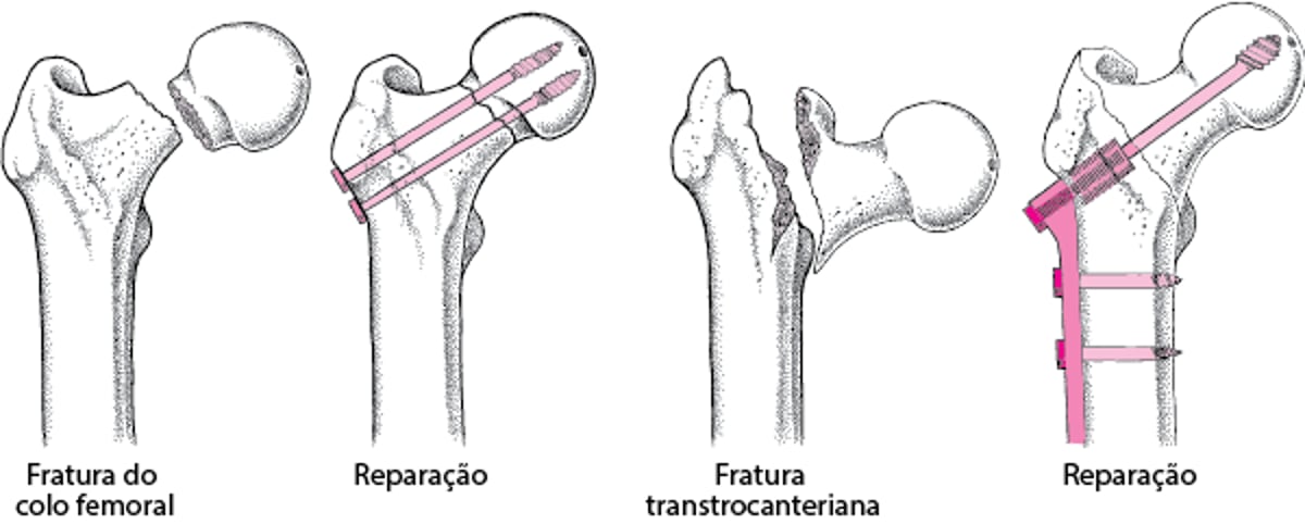 Reparação de uma fratura do quadril