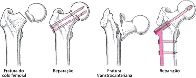 Reparação de uma fratura do quadril