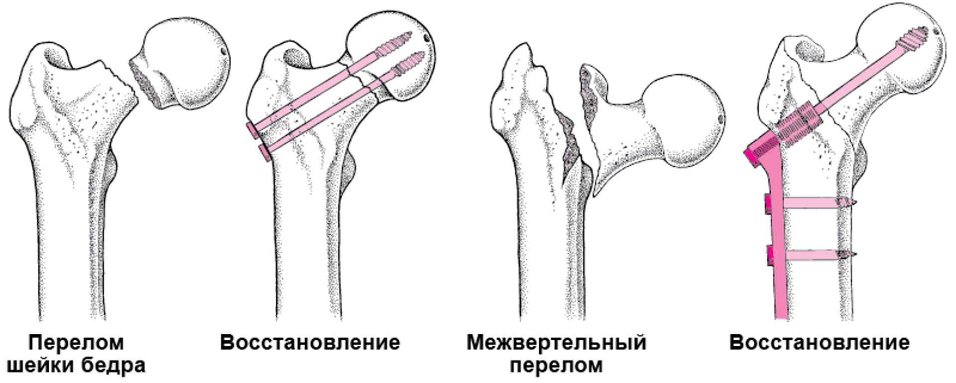 Восстановление перелома тазобедренного сустава