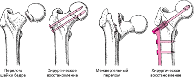 Восстановление перелома тазобедренного сустава