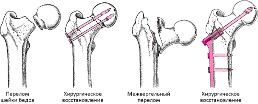 Восстановление перелома тазобедренного сустава