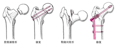 髋关节骨折的修复