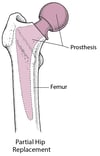 Replacing a Hip
