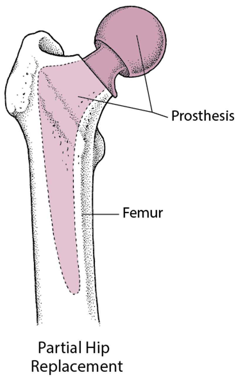 Replacing a Hip